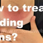 How-to-treat-Welding-Burns